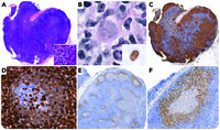 Hiding in the mantle mantle cell lymphoma with a mantle zone growth