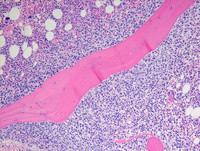 Transformed Follicular lymphomaBone marrow biopsy H&E