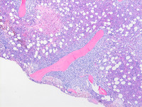 Transformed Follicular lymphomaBone marrow biopsy H&E