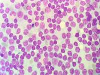 Chronic lymphocytic leukemia Nuclei with ''Soccer ball chromatin''