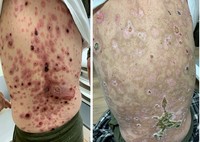Total Skin Electron Therapy and Cutaneous TCell Lymphoma