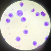 Pericardial Fluid with Mesothelia cells in patient with Sjogren