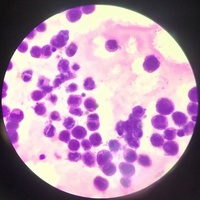 Pericardial Fluid with Mesothelia cells in patient with Sjogren