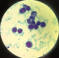 Pericardial Fluid with Mesothelia cells in patient with Sjogren