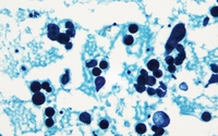 Pericardial Fluid with Mesothelia cells in patient with Sjogren