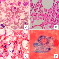 Gaucher's disease Cytochemical diagnosis