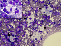 Neiman pick disease Type C Classical morphology