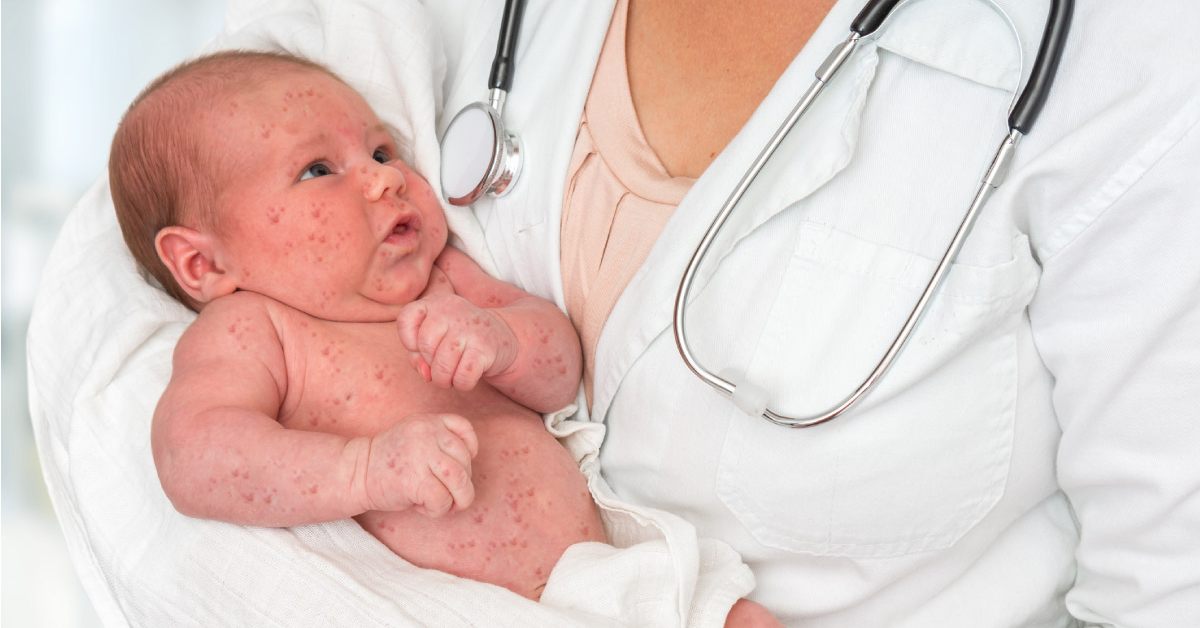 Herpes en bebés ¿por qué se producen y cómo tratarlos?