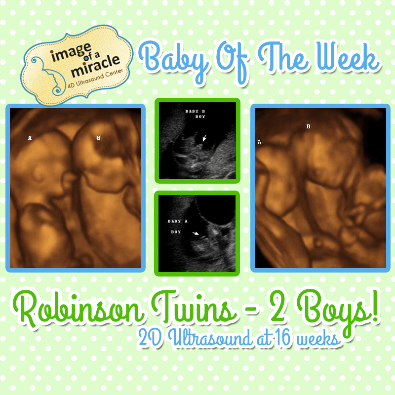 Baby of the Week Robinson Twins! Image of a Miracle 4D Ultrasound