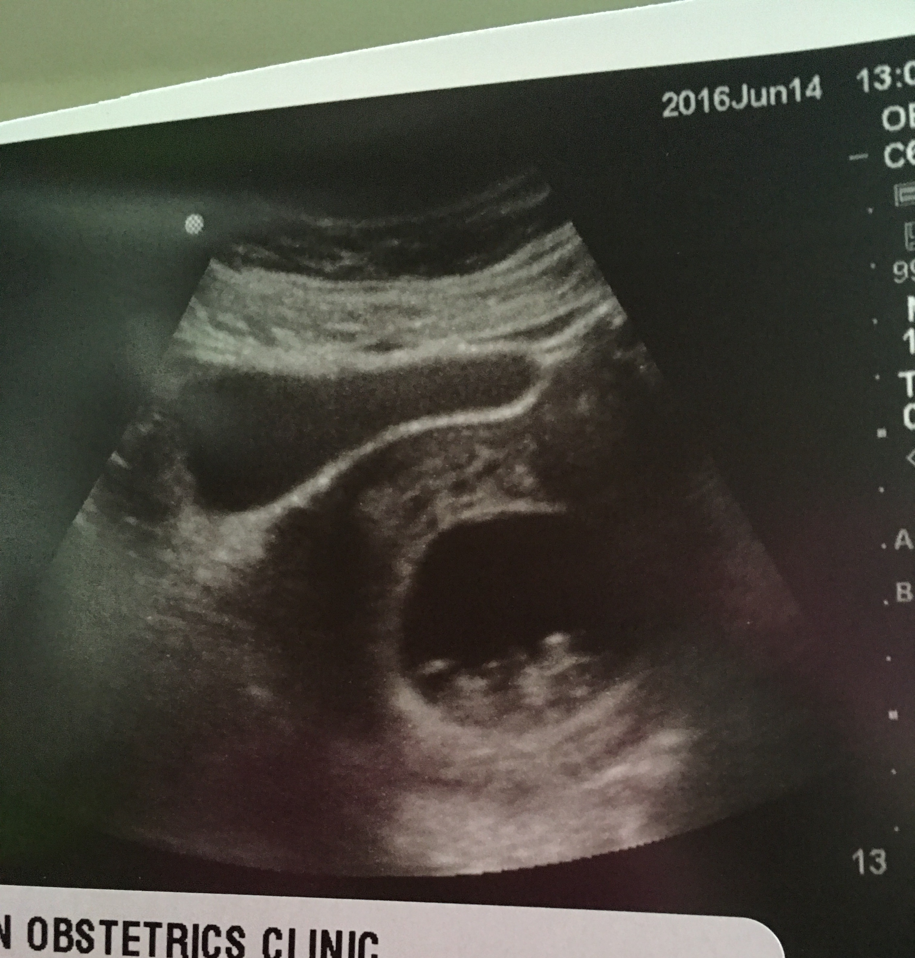Black Spots On Ct Scan Of Abdomen ct scan machine
