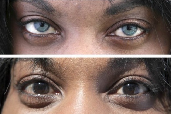 Eye New Types Of Cosmetic Surgery