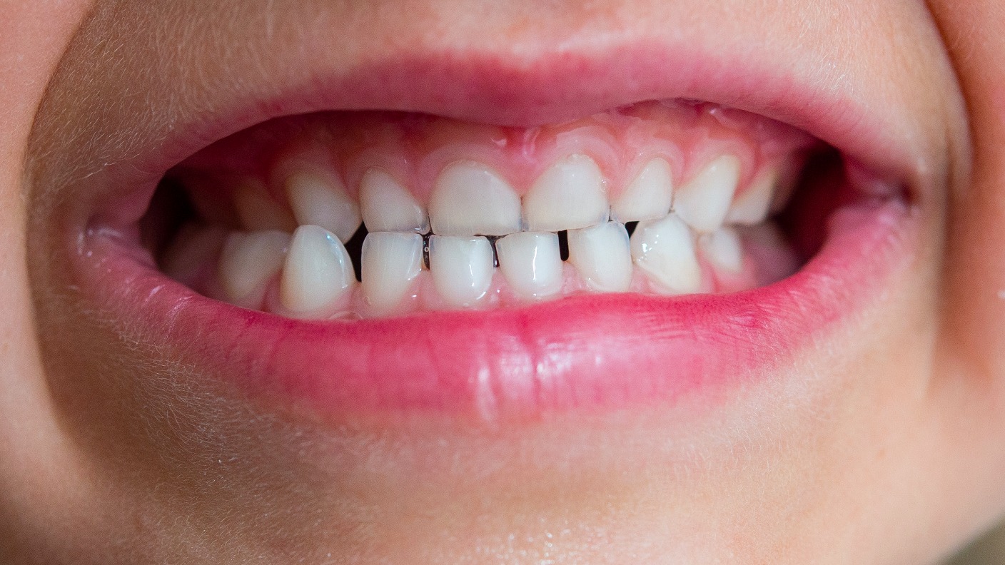 Tooth Decay Is The Most Common Reason For Young Children To Go Into Hospital | Itv News Wales