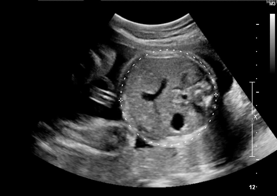 Automatic Estimation of Fetal Abdominal Circumference from Ultrasound
