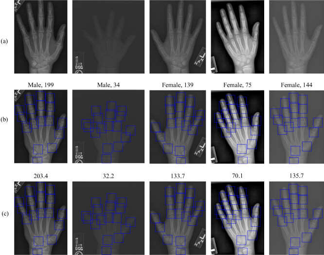 Improve bone age assessment by learning from anatomical local regions