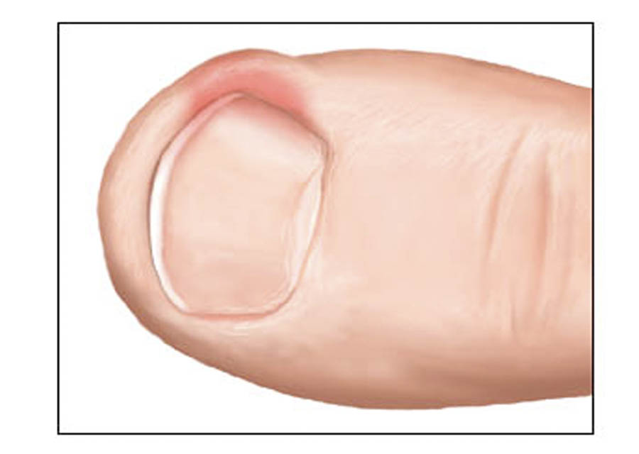 Ingrown Toenail prevention, treatment and removal Long Beach Sol Foot