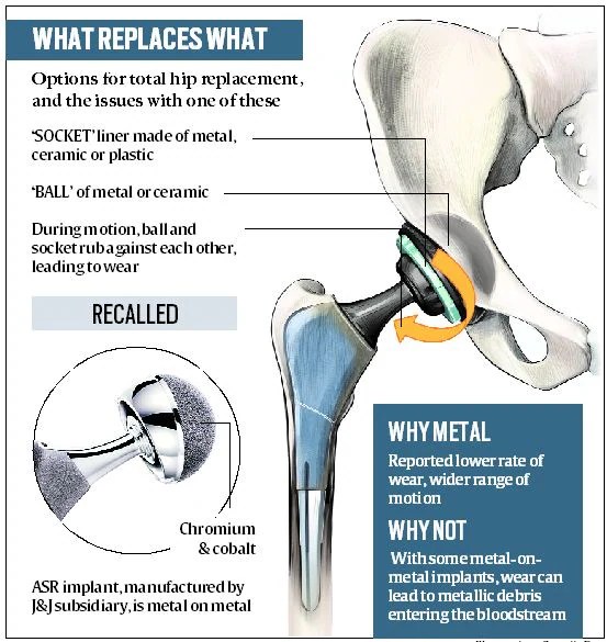 Ceramic Ball Hip Replacement Best Image Home