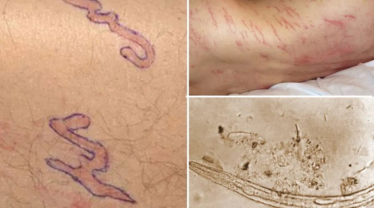 Acute case of this rare infection caused worms to crawl under man’s