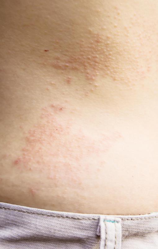 What is Belt Buckle Rash? (with pictures)
