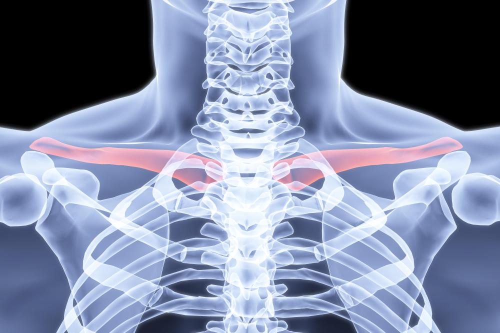 What Causes a Clavicle Bone Lump? (with pictures)
