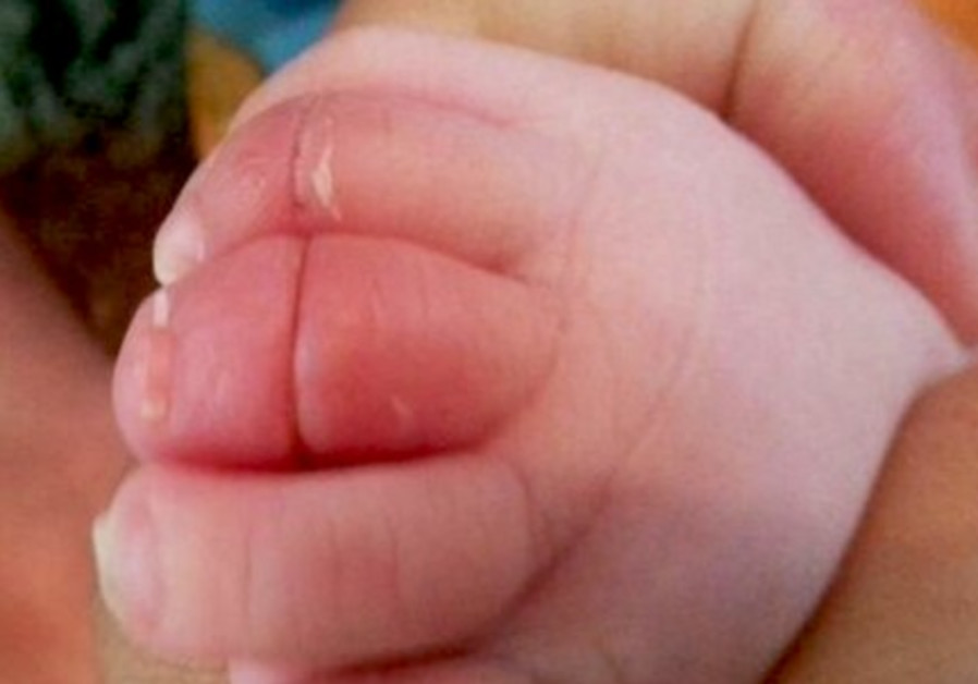 Baby's toes mangled after light colored hair cuts off blood circulation