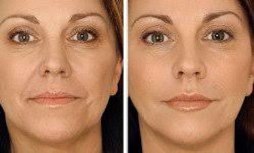 HyaluronPen® HyaluroPen Pressurizada Intradermo Aplicação