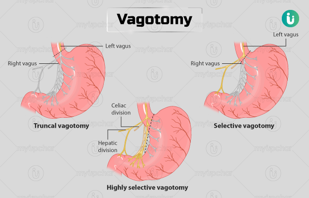 Vagotomy Procedure, Purpose, Results, Cost, Price