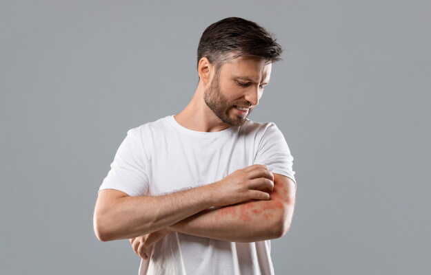 त्वचा से फंगल इंफेक्शन के निशान कैसे हटाएं How to remove fungal
