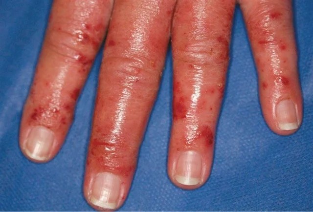 contact dermatitis Encyclopedia NAILS Magazine