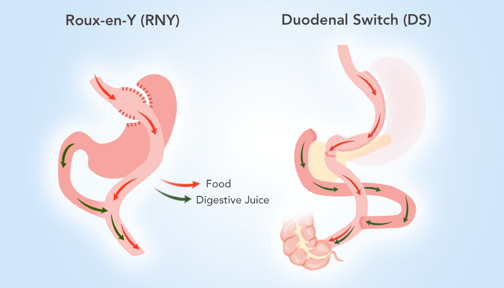 What to Expect of a Revision from RNY to DS ObesityHelp