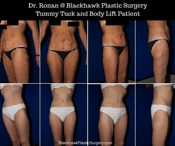 Top 7 Plastic Surgery Procedures for Extreme Weight Loss Patients ObesityHelp