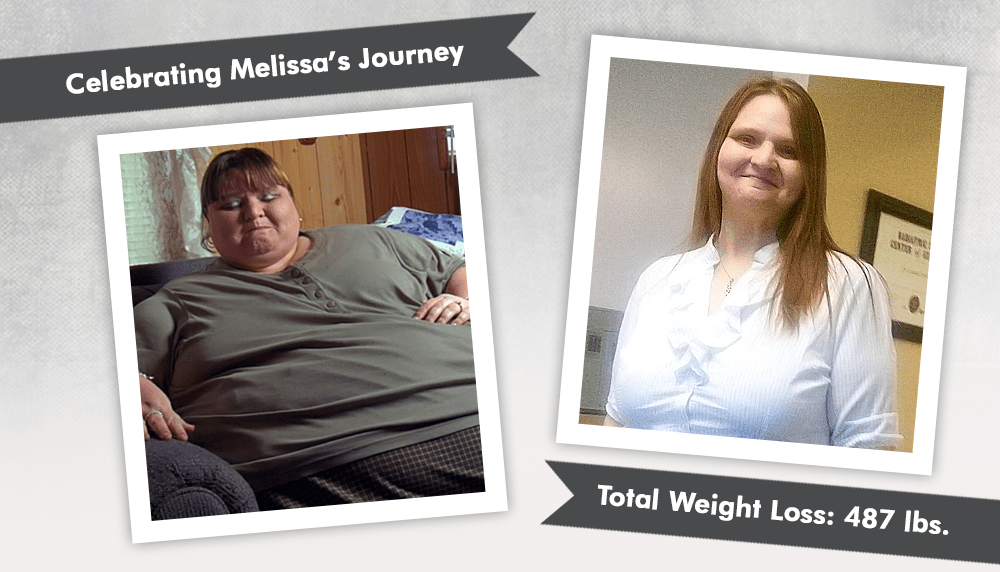 Before & After RNY with Melissa of My 600lb Life! ObesityHelp