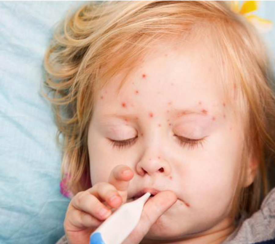 Deadly measles cases are more common than believed