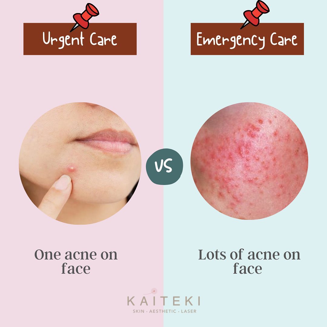 Acne Breakouts Treatments, Causes, And More According To An Expert