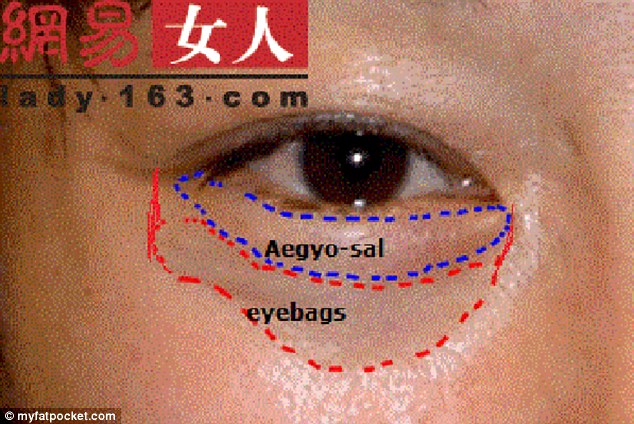 You Hate Eye Bags? Koreans Don't, And They're Getting Plastic Surgery