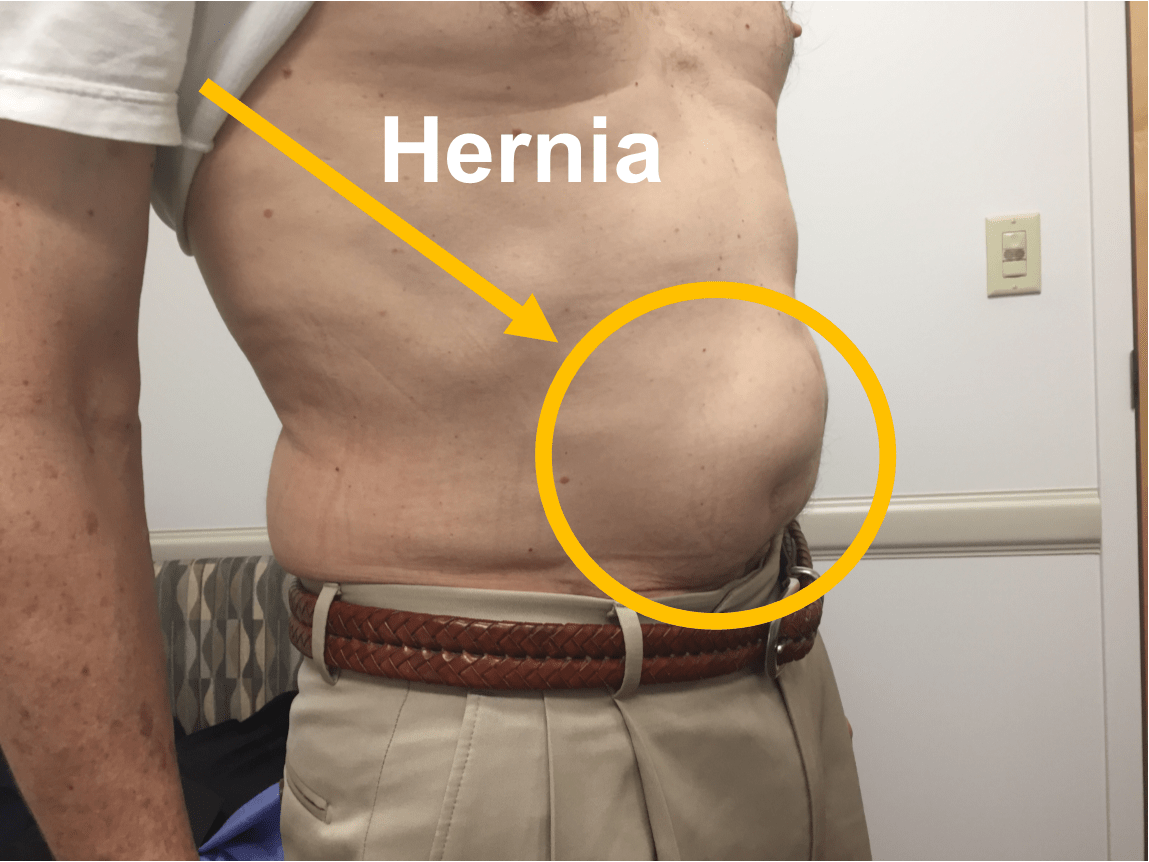 Sakit Perut Belah Kanan Appendisitis Atau Bukan? Ini Perkara Penting