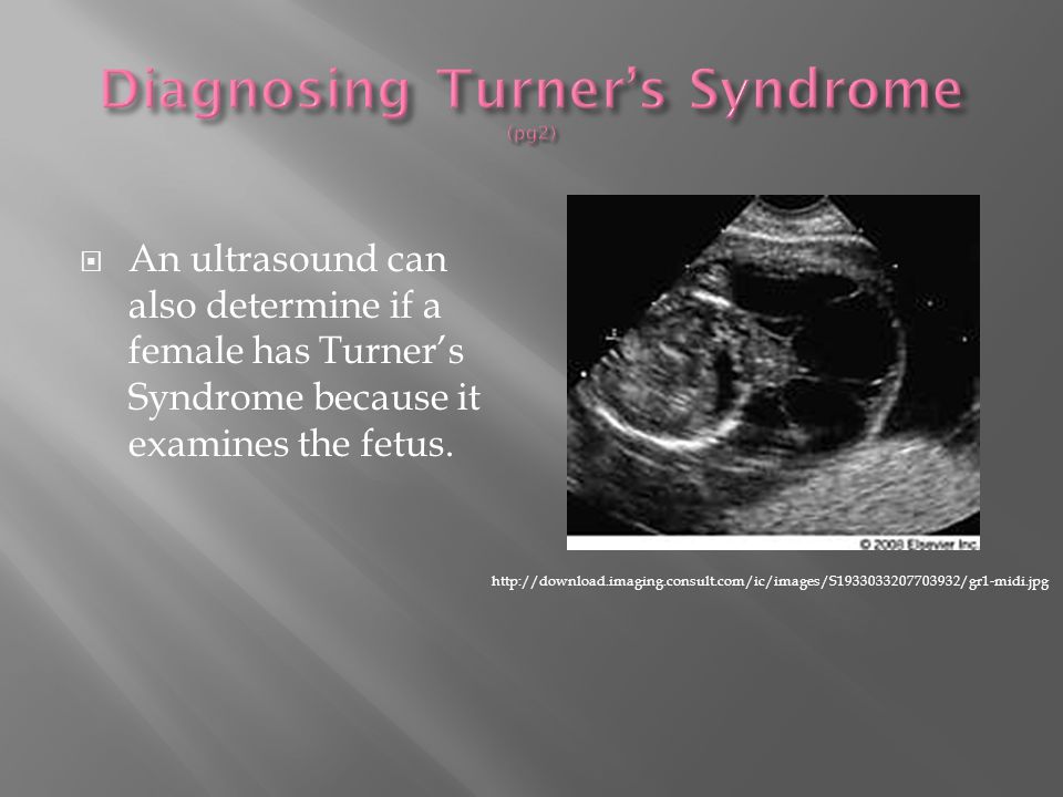 Turners Syndrome Ultrasound