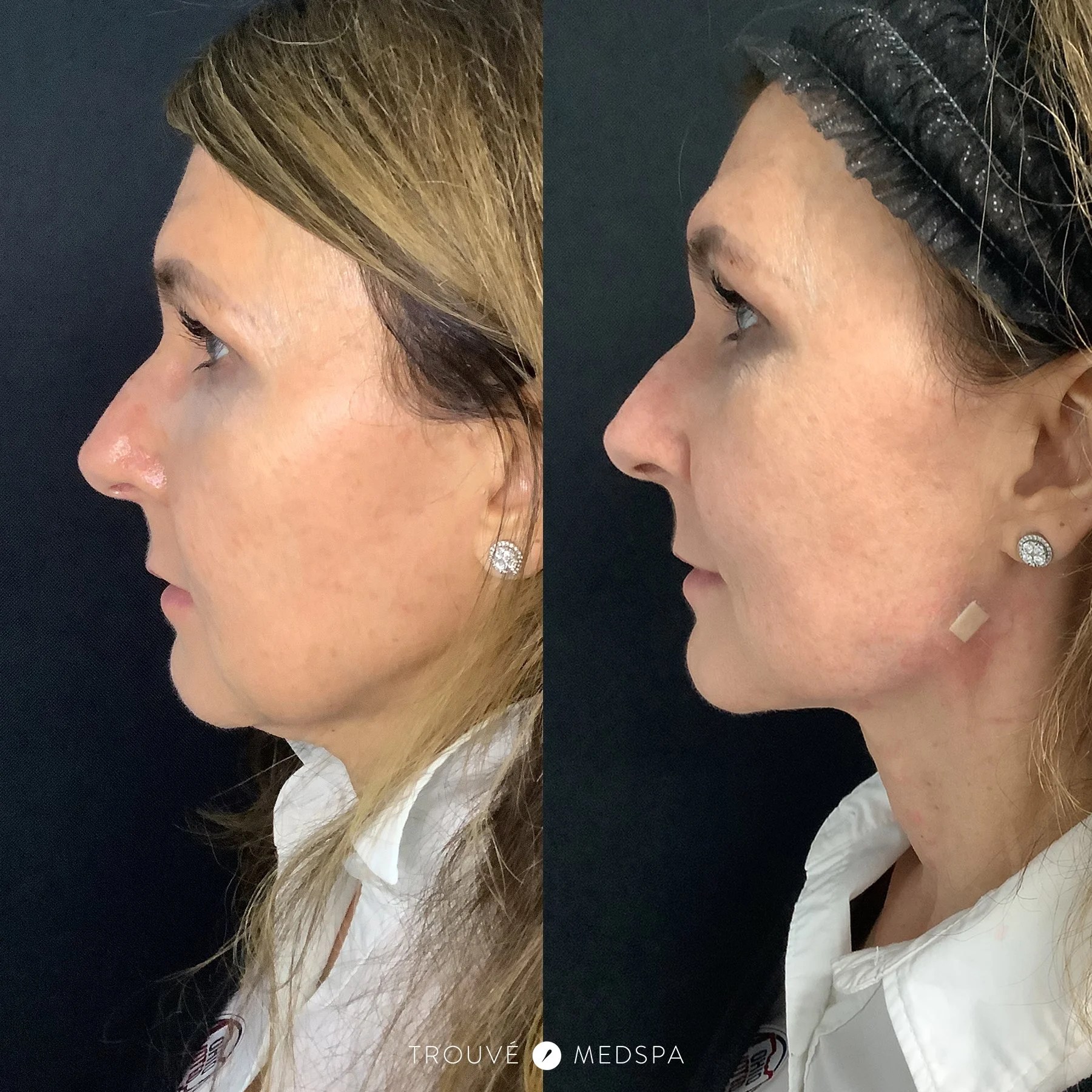 Trouvé Medspa Contour Jawline Cleveland