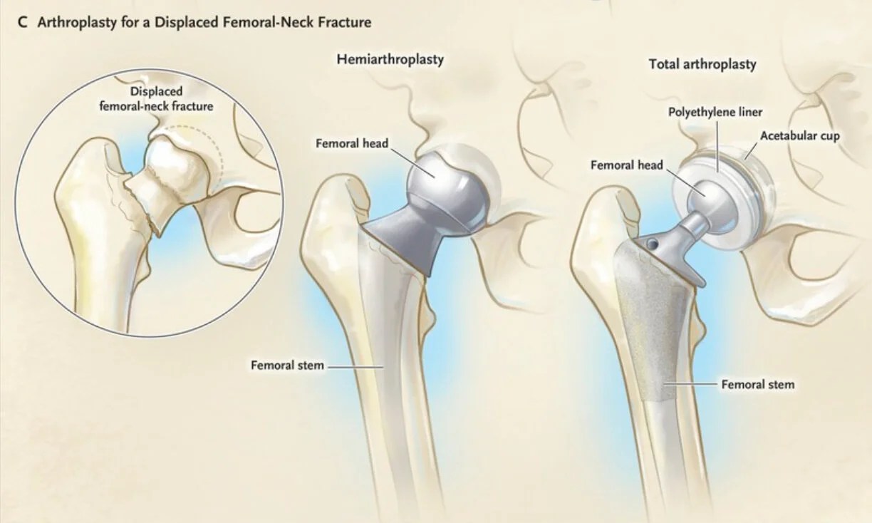 Common Types of Hip Replacement — Han Orthopaedics