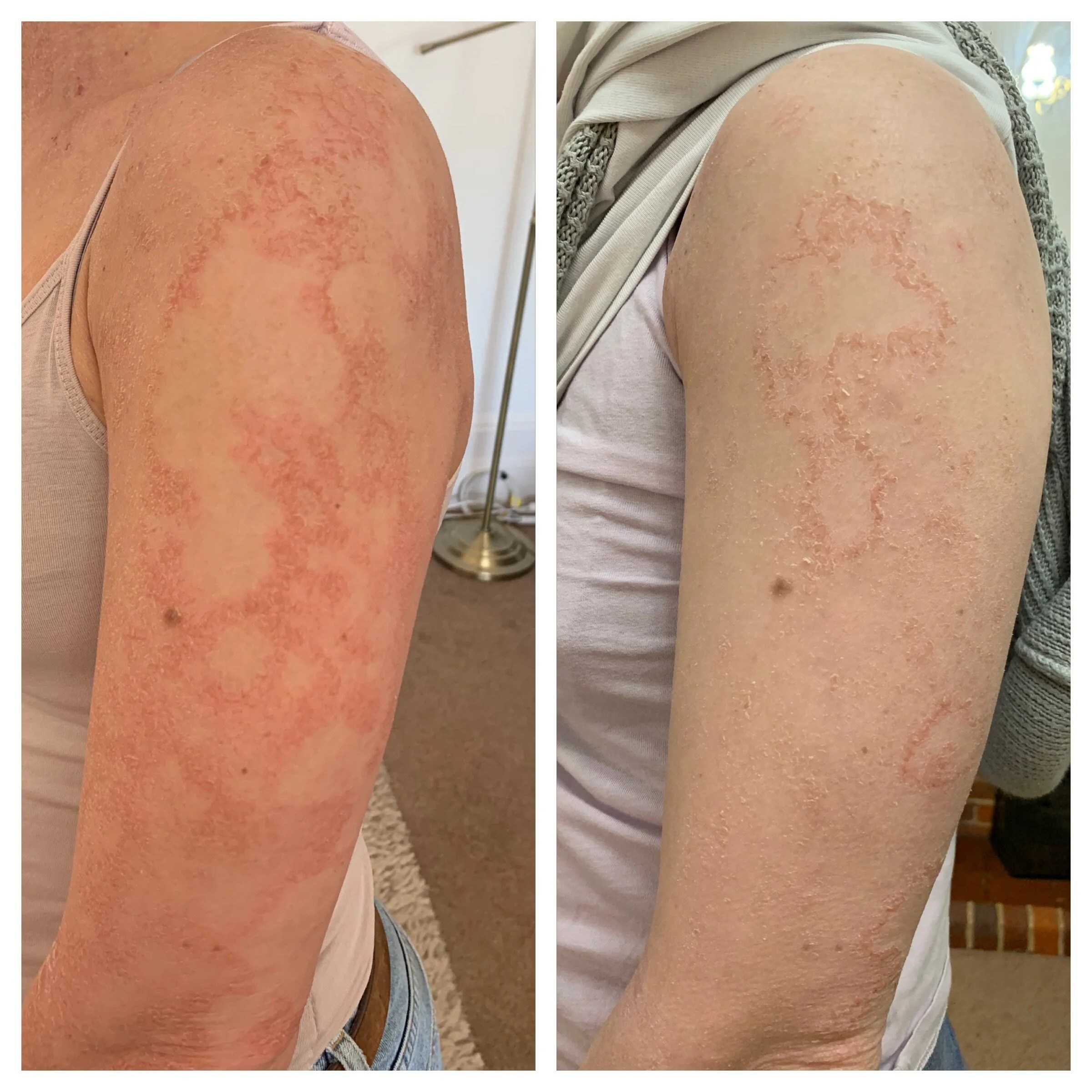 Identifying And Managing Fungal Infections — Decoding Topical Steroid Withdrawal