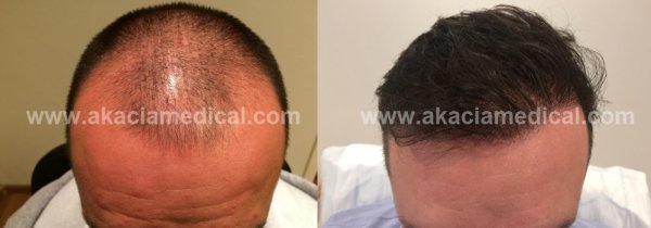 Hårtransplantation Stockholm Vi garanterar tjockare hår