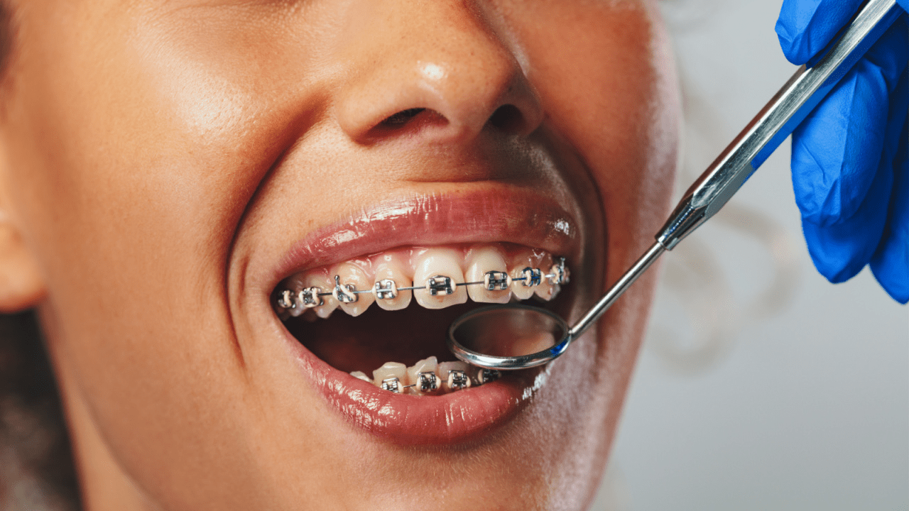How Much Do Braces Cost in the UK? From Train Tracks to Invisalign