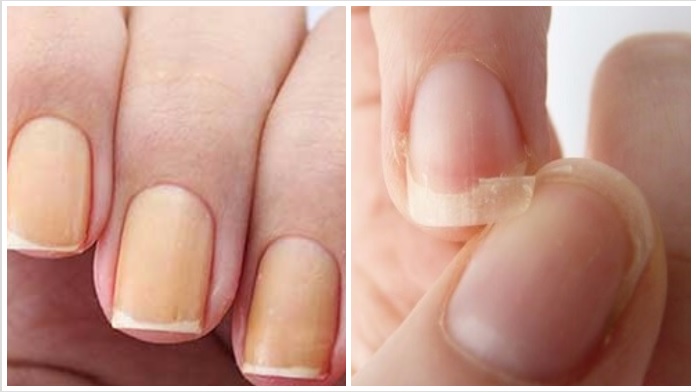 Sete dicas poderosas para recuperar unhas quebradiças e amareladas