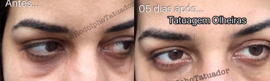 G1 Tatuador desenvolve técnica em Cuiabá para 'camuflar' estrias Descobrimos tudo sobre as tatuagens para camuflar estrias e olheiras