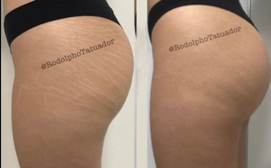 G1 Tatuador desenvolve técnica em Cuiabá para 'camuflar' estrias Descobrimos tudo sobre as tatuagens para camuflar estrias e olheiras