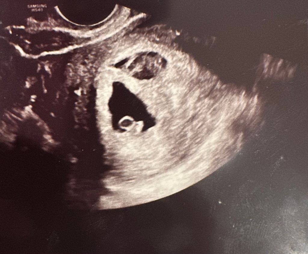 Blood clot in uterus 1st Pregnancy Forums What to Expect