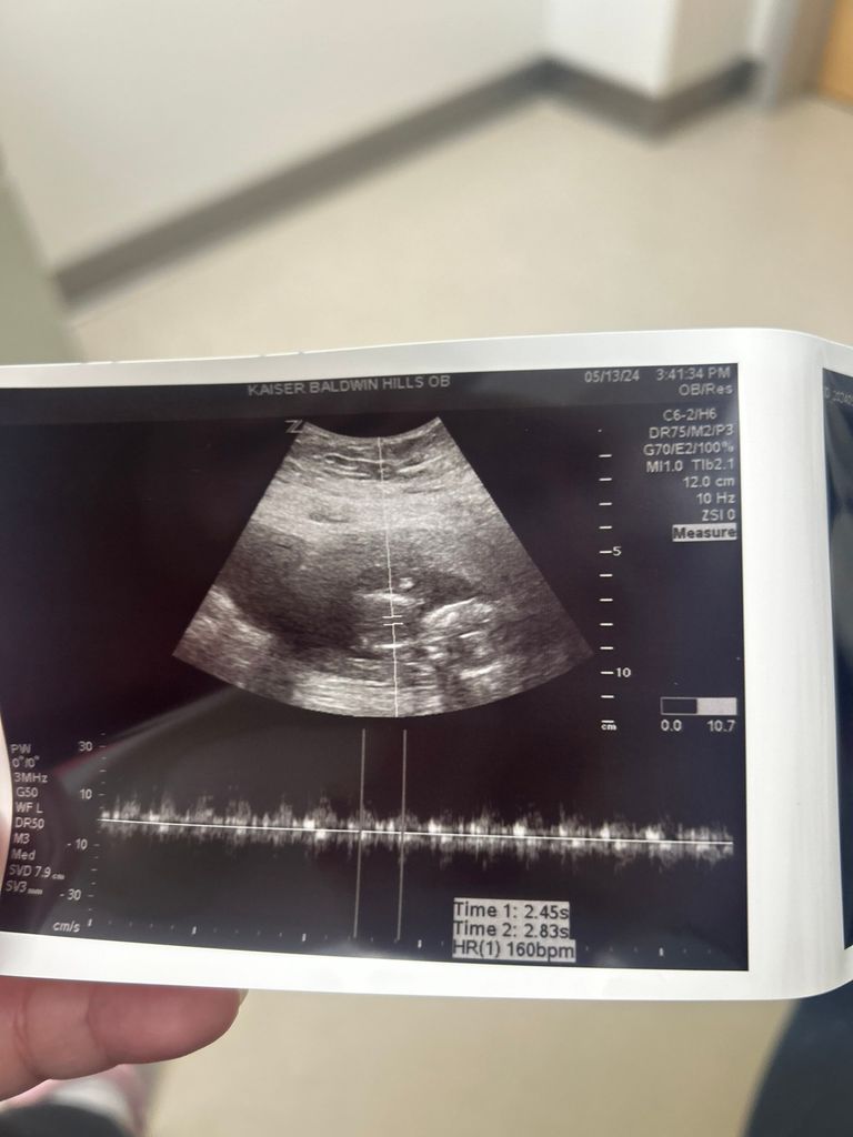 Is my baby too small? November 2024 Babies Forums What to Expect