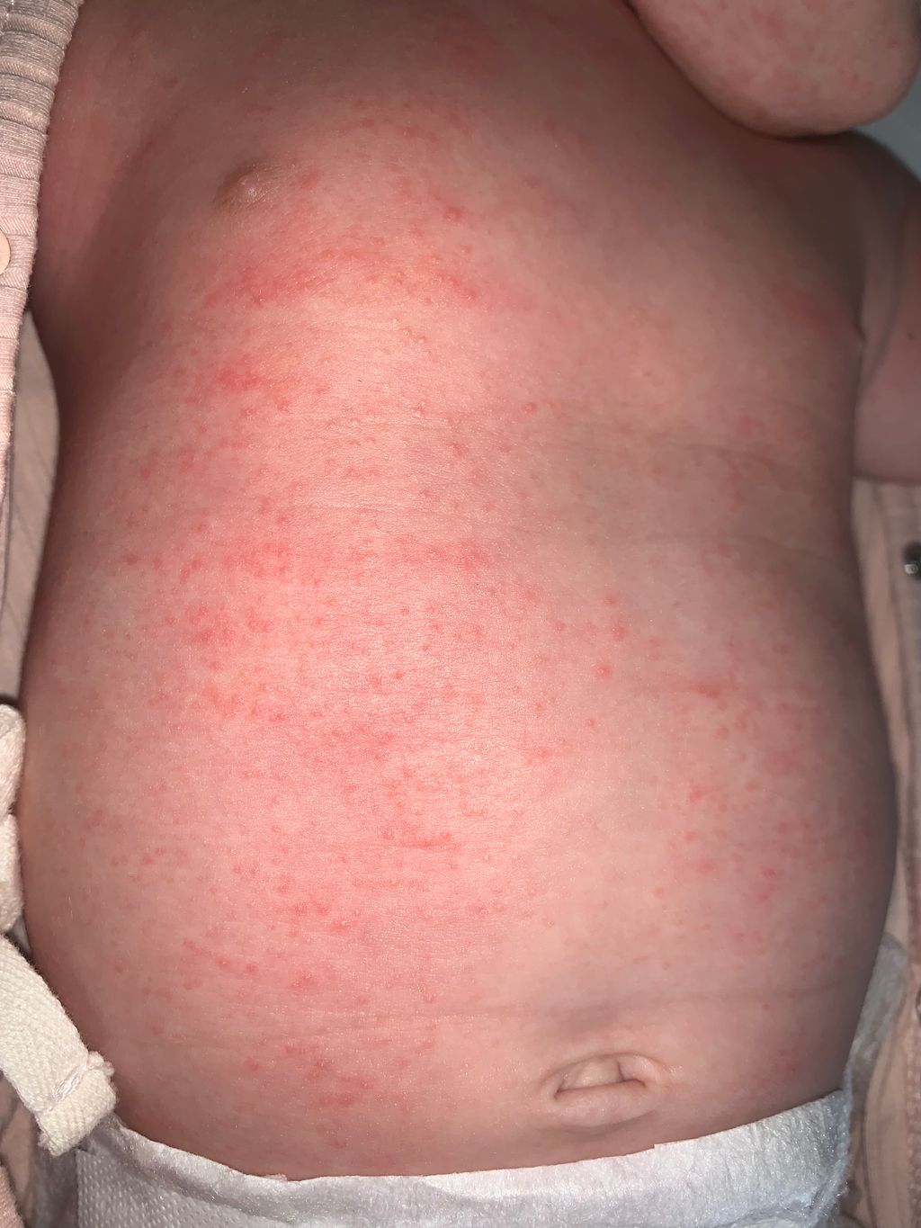 Infant Acne On Chest
