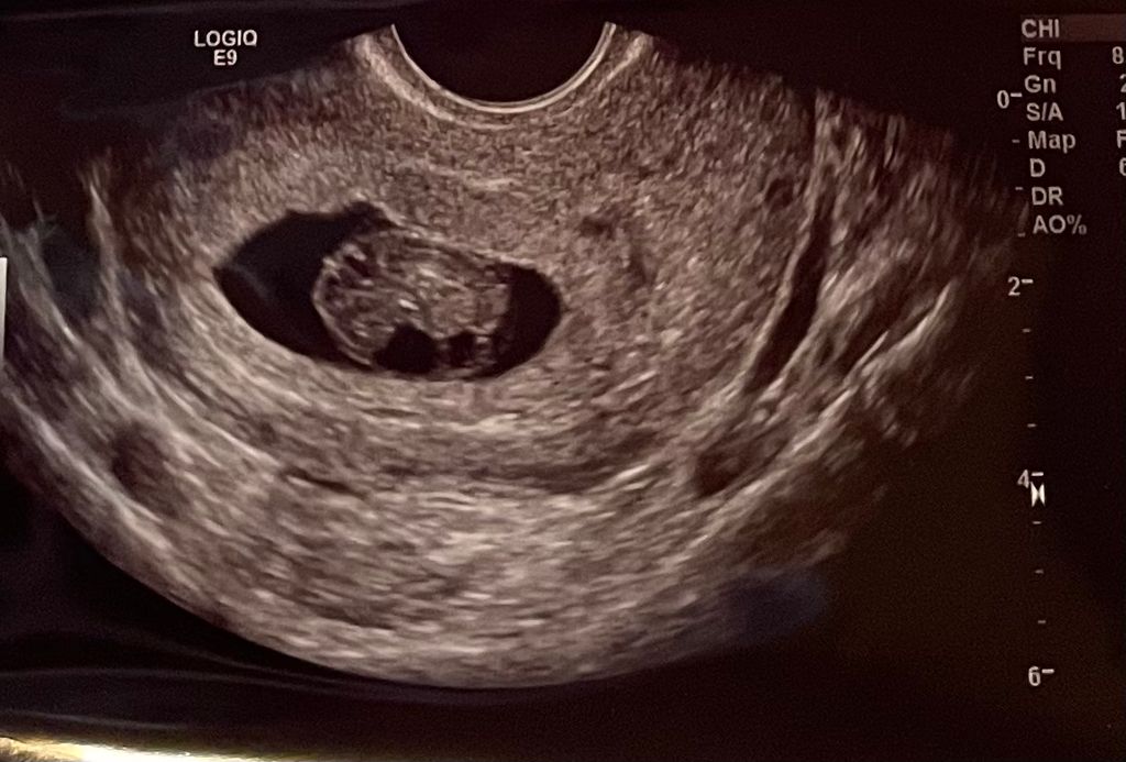 9 weeks 1st Pregnancy Forums What to Expect