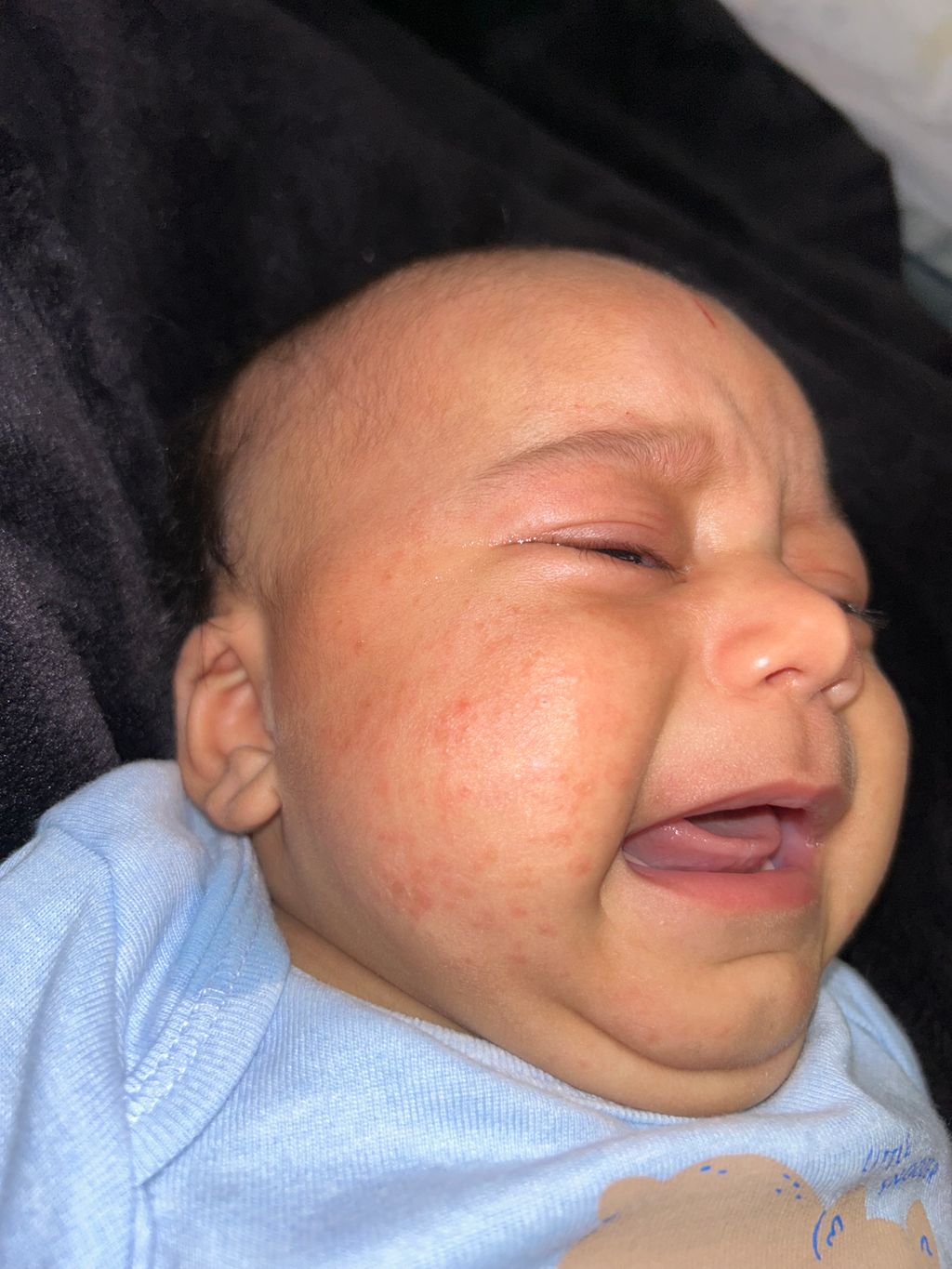 Rash on babies face , Pic included February 2024 Babies Forums