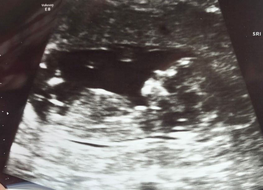 12 week scans & multiple kids anyone have similar looking scans
